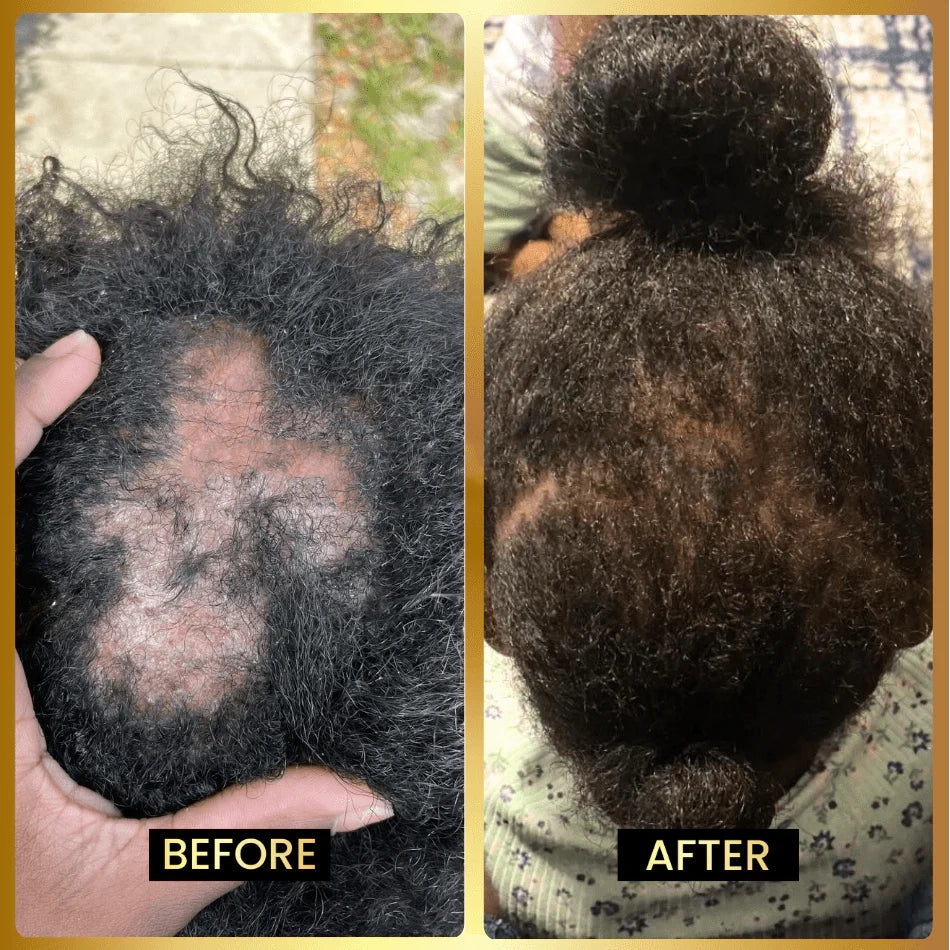 SEAGRIL Scalp Stimulator | Hair Growth Oil
