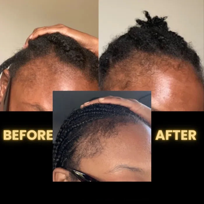 SEAGRIL Scalp Stimulator | Hair Growth Oil